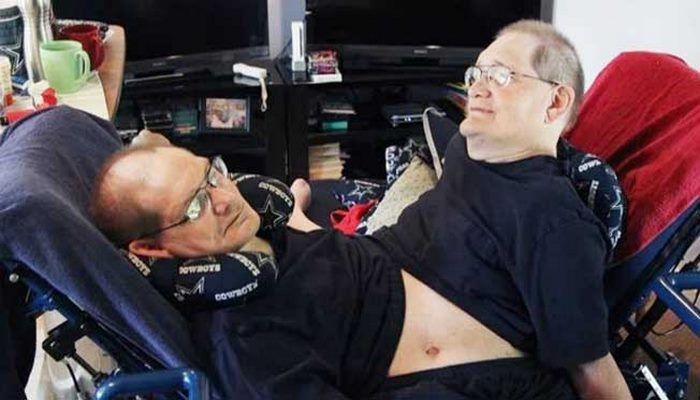 Dünyanın ən qoca Siam əkizlərindən biri ölsə, digərini öldürməli olacaqlar