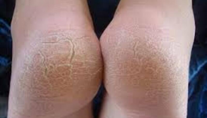 Daban çatlarından qurtulmaq üçün ideal vasitələr