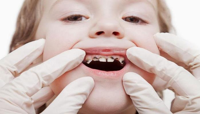 Uşaqlarda diş çürümələri niyə artıb?