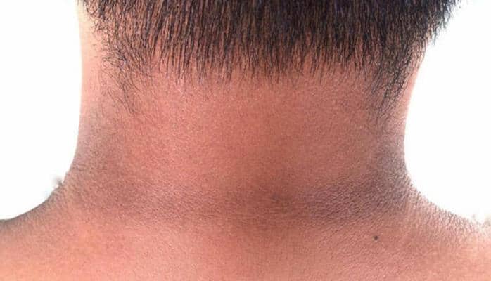 Boynun qaralması hansı xəstəliyin simptomlarıdır?