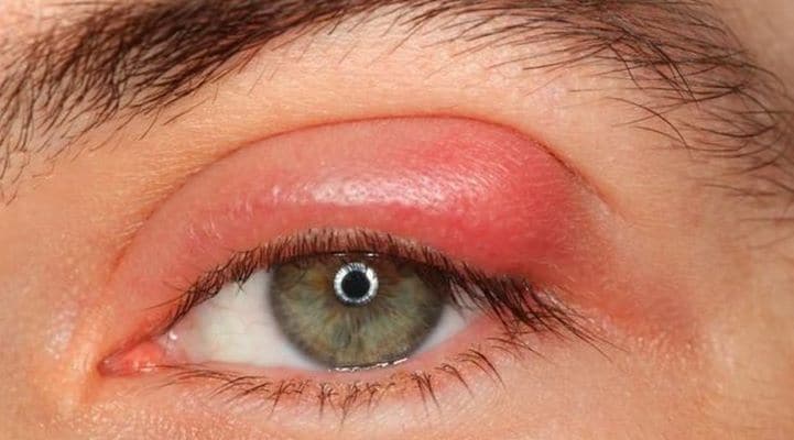 İtdirsəyi niyə çıxır? Ev şəraitində müalicəsi