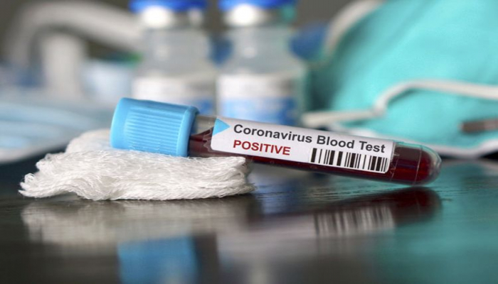 Britaniyada son sutkada koronavirusdan 282 nəfər ölüb