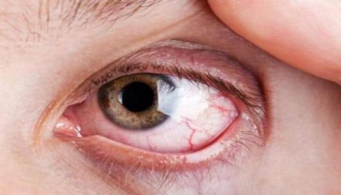 Как лечить конъюнктивит?