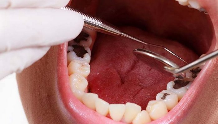 Dişlərin tez çürüməsinə səbəb olan 10 qida