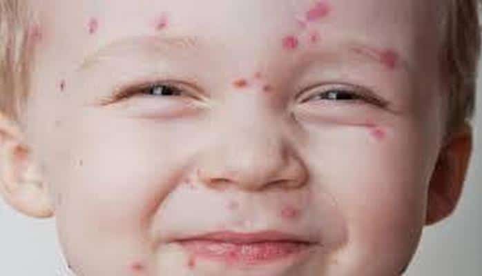 Минздрав Азербайджана о ситуации в связи заболеваемостью ветрянкой