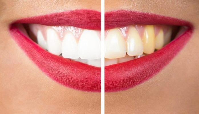 Sarı dişlərdən və diş daşlarından necə qurtulmaq olar?