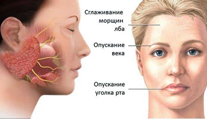 Невралгия тройничного нерва