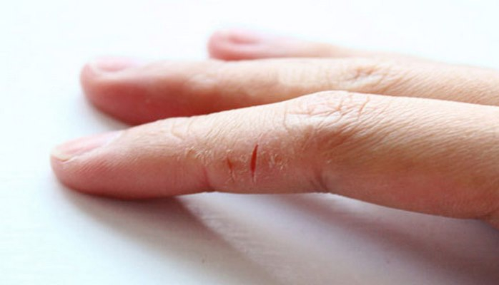 Əllərdə çatlar. Səbəblər və çarələr