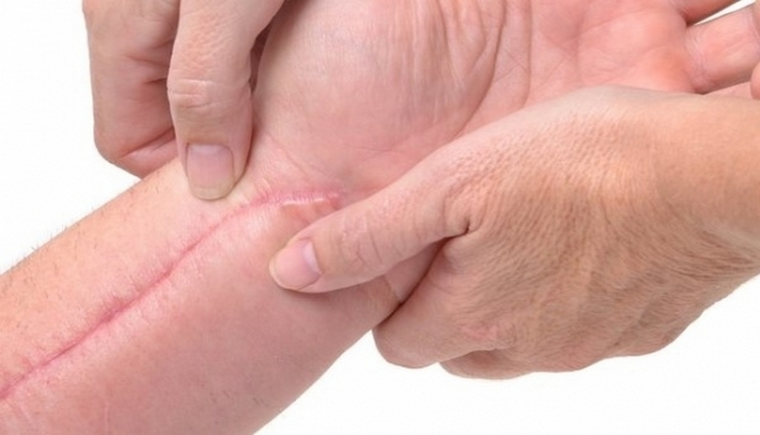 Yara izlərini yox edən GEL - Alimlərin yeni kəşfi