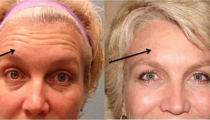 Botoksu əvəz edən maska! - Nişastalı reseptlə gənc qız dərisinə sahib olacaqsınız