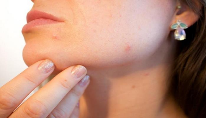 Учёные рассказали о влиянии гормонов на появление на коже угрей