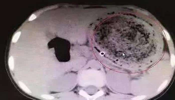 Девочка шесть лет ела волосы и вырастила колтун в желудке