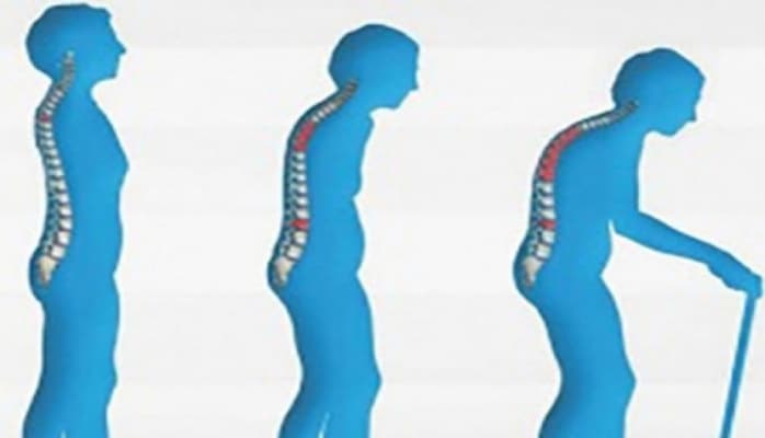 Bu gün Dünya Osteoporozla Mübarizə Günüdür