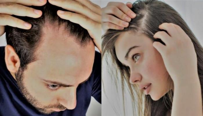 Saç tökülməsindən əziyyət çəkənlərə şad xəbər: bir neçə saata ev şəraitində...