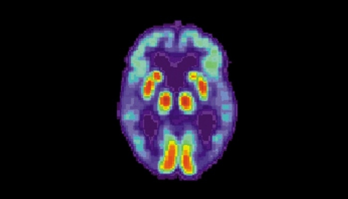 Süni intellekt Alzheimer xəstəliyini 6 il öncədən proqnoz verir