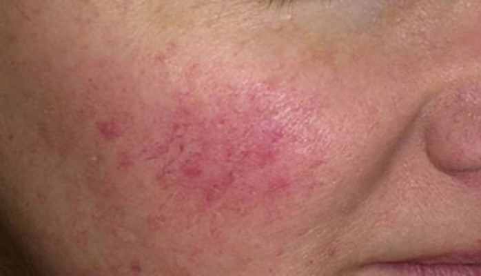 Kuperoza qarşı mübarizədə damar divarının möhkəmlənməsi müsbət təsirə malikdir