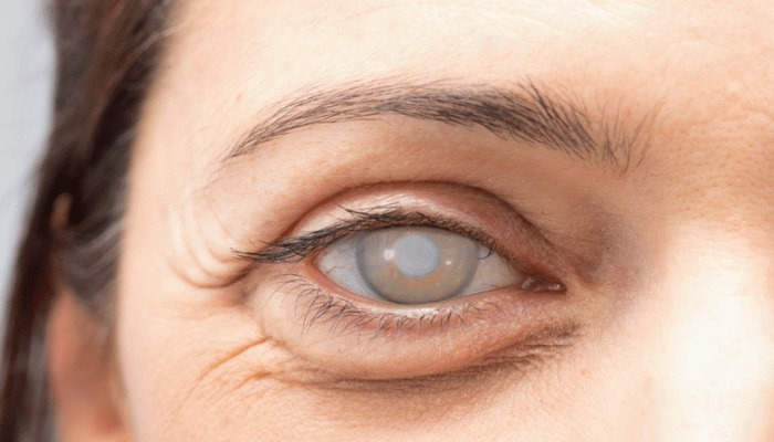 "Toyuq korluğu" – Hemeralopiya: Yaranma səbəbi, müalicəsi, risk faktorları