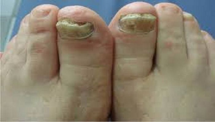 Barmaqlarınızdakı bu ləkələr koronavirusun əlamətidir