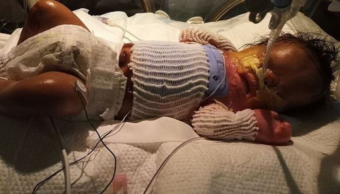 Dərisiz doğulan körpə sağ qalacaqmı? – Tibdə kuryoz