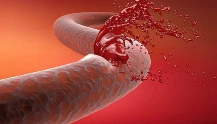 Daxili qanaxma nədir? - Əlamətləri, səbəbləri və ilkin tibbi yardım