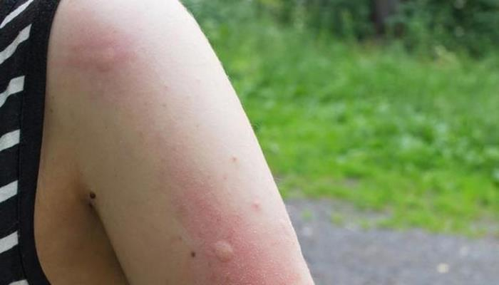 Məşhur dermatoloq yay aylarında qaşıntını dərhal kəsən üsulları açıqladı