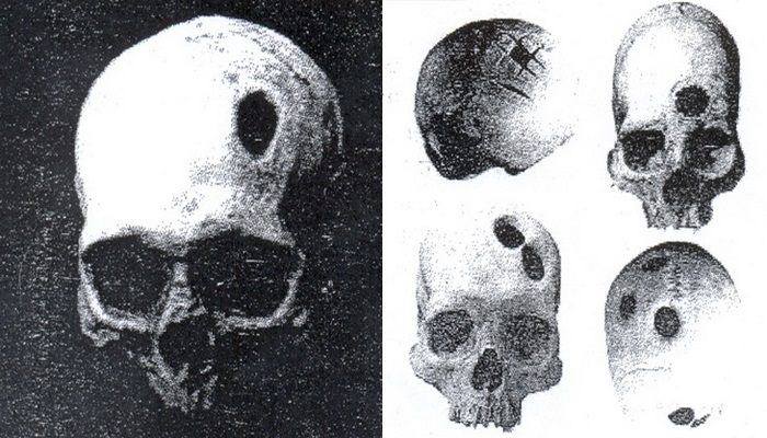 О трепанации черепа на территории древнего Азербайджана