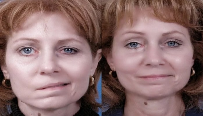 İnsultdan necə qorunmaq olar?