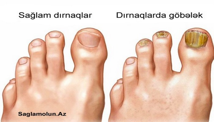 Dırnaqlarda göbələyin xalq təbabəti vasitələri ilə müalicəsi