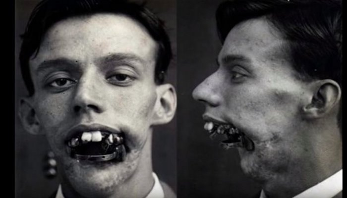 Dünyada ilk plastik əməliyyatın tarixi