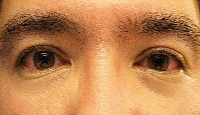 10 вещей, которые могут рассказать о здоровье наши глаз