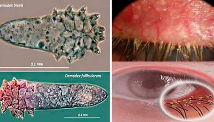 Kirpik gənəsi xəstəliyi nədir? – Xəbərdar olun ki, qorunasınız!