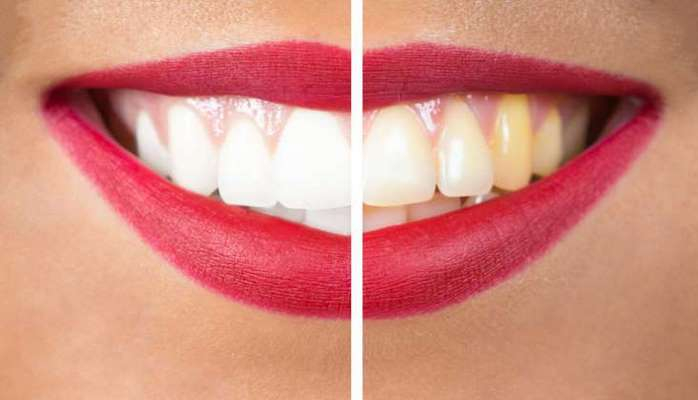 Bu üsullarla dişlərinizi sürətli və asan şəkildə ağardın
