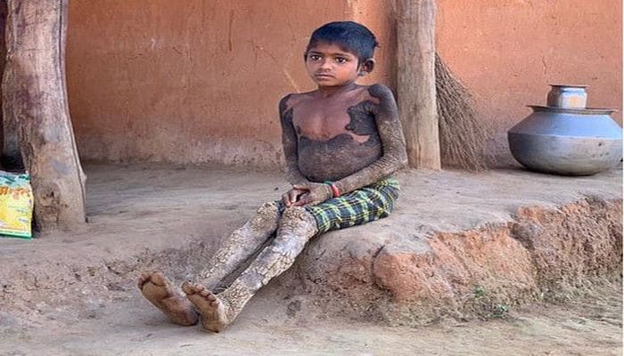 Семилетняя девочка «превращается в камень» из-за редкого заболевания