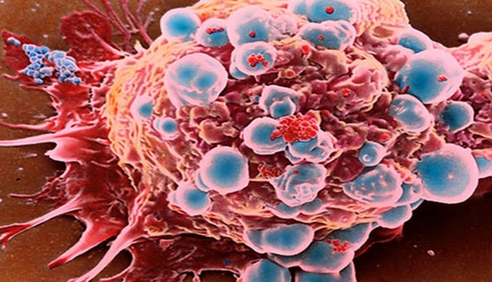 Xərçəng xəstəliyi niyə sürətlə artır və gəncləşir?