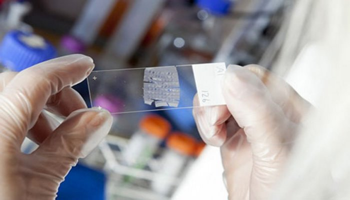 Bu qan qrupu olanlarda xərçəng riski yüksəkdir - 35 illik araşdırma