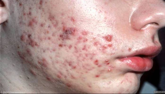 Sızanaqlar necə yaranır? Akne Vulqaris