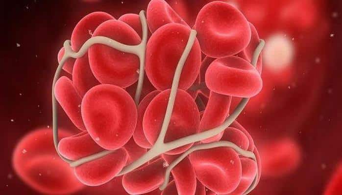 Эксперты рассказали, как предотвратить появление тромбоза