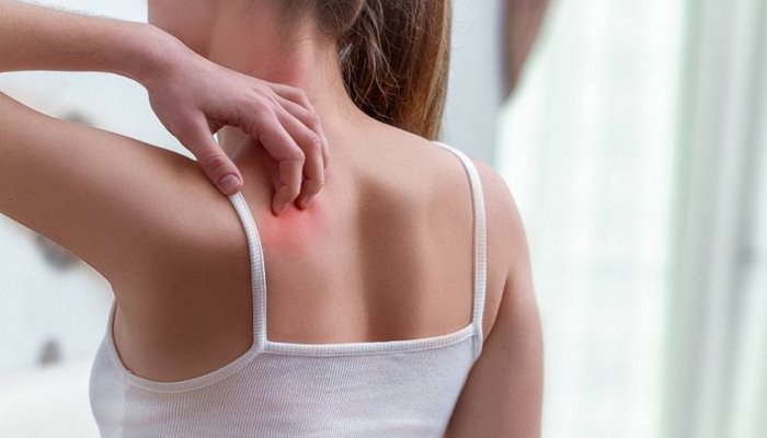 Bədəndə güclü qaşınma – 12 səbəb və müalicə