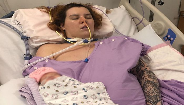 Пациентка с аневризмой мозга родила здорового малыша, находясь в коме
