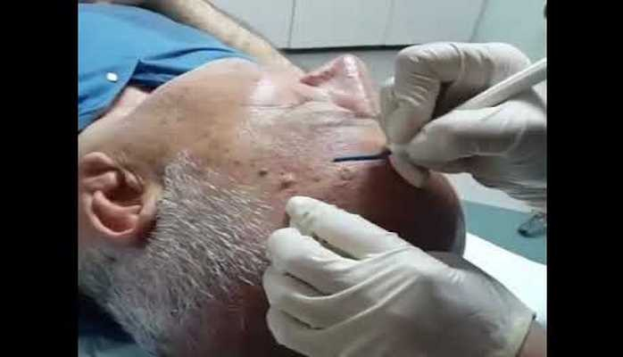 Xalların götürülməsi xərçəngə səbəb ola bilər - Dermatoloq yanaşması