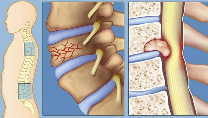 Bel ağrılarının səbəblər
