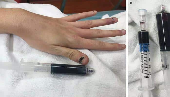 Кровь американки стала синей после приема обезболивающего