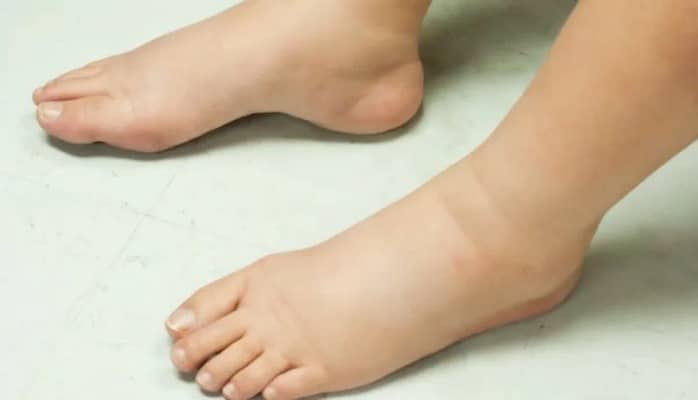 Nə üçün ayaqlarımız şişir? - Səbəbləri və müalicəsi