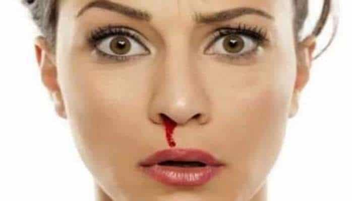 Burun qanaması nədən xəbər verir? - Səbəbləri və müalicəsi
