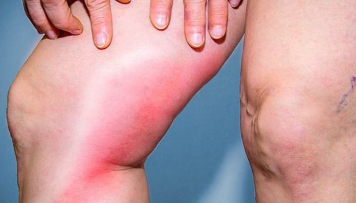 Sizdə tromb olduğunu göstərən 6 əlamət – Ölümün bir addımlığında