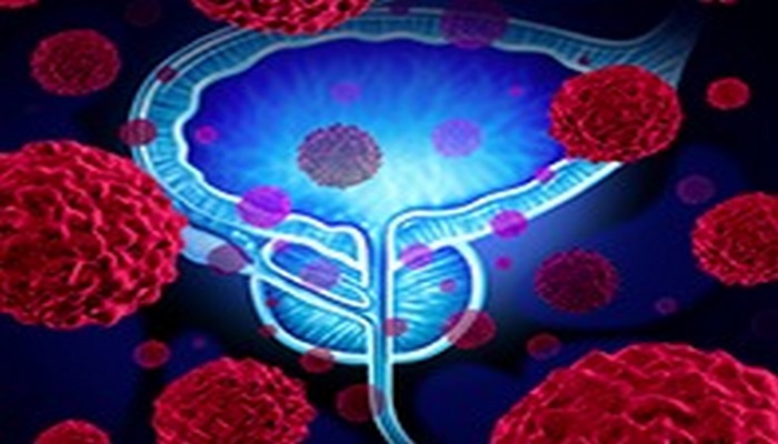 Alimlər ən aqressiv də daxil olmaqla prostat xərçənginin iki növünə qalib gəldilər