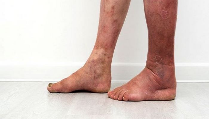 Ayaqda trombozu necə aşkar etmək etməli?