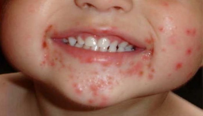 Azərbaycanda azyaşlılar arasında daha bir virus yayılıb - VİDEO