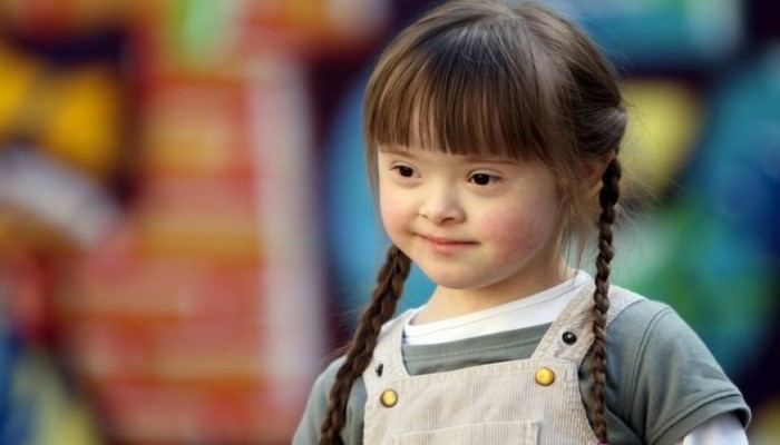 Azərbaycanda iki minə yaxın daun sindromlu əlilliyi olan şəxs var