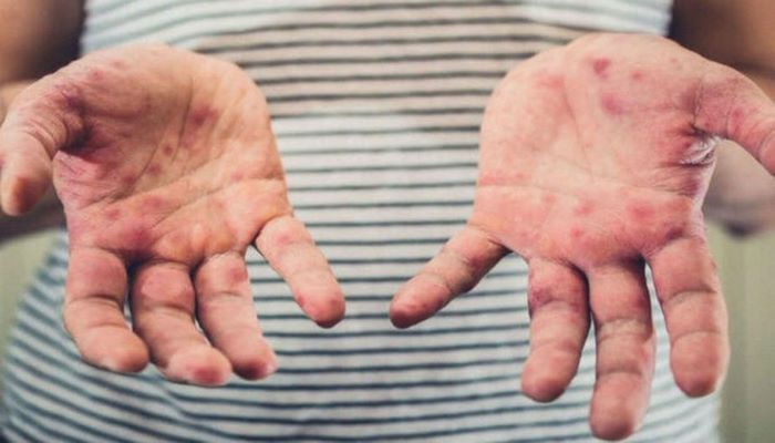 Azərbaycanda qızılca ilə bağlı son vəziyyət açıqlanıb